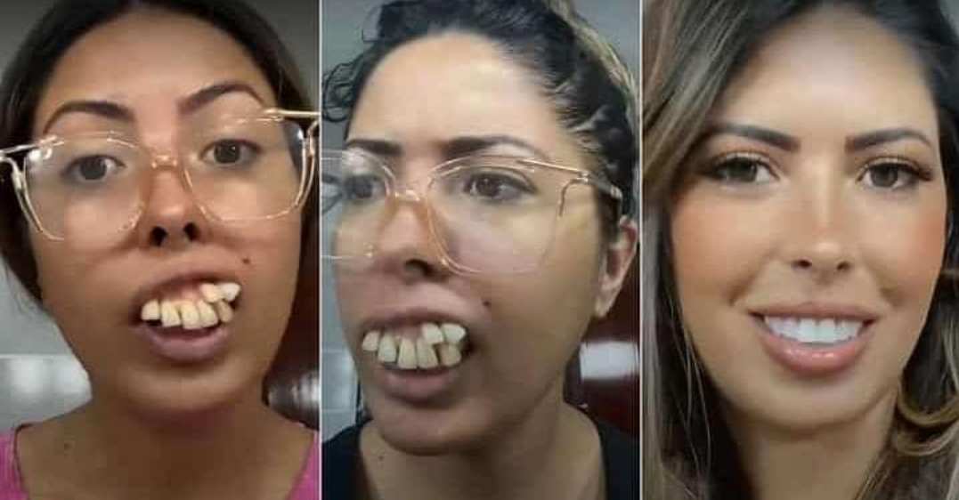 Lady With Crooked Teeth Shows off Transformation After Undergoing Dental Surgery, Video Trends Read more: